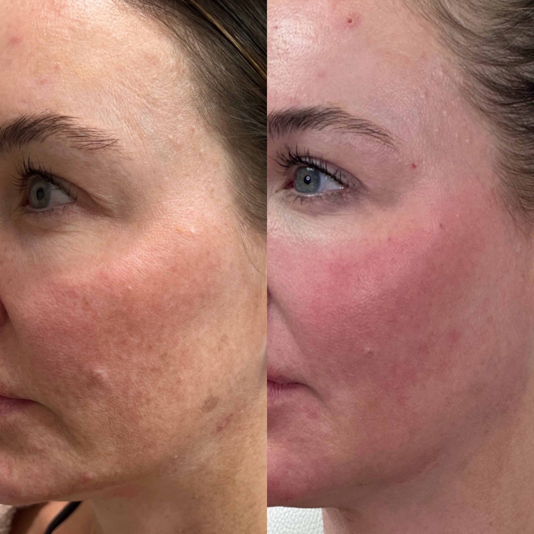 Laser Coring Eyes and Clear Face, Neck & Chest1