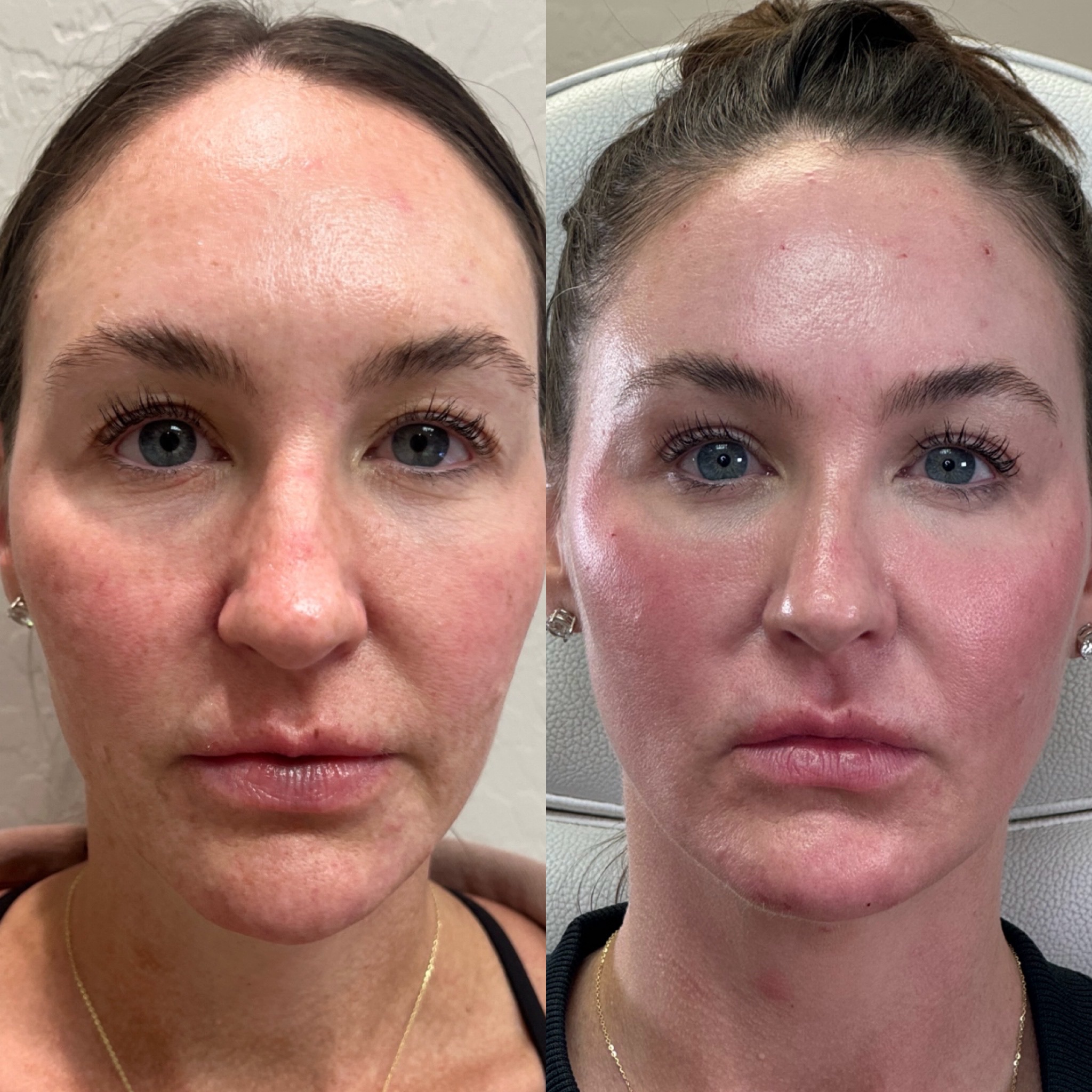 Laser coring eye and Clear Face, Neck & Chest2