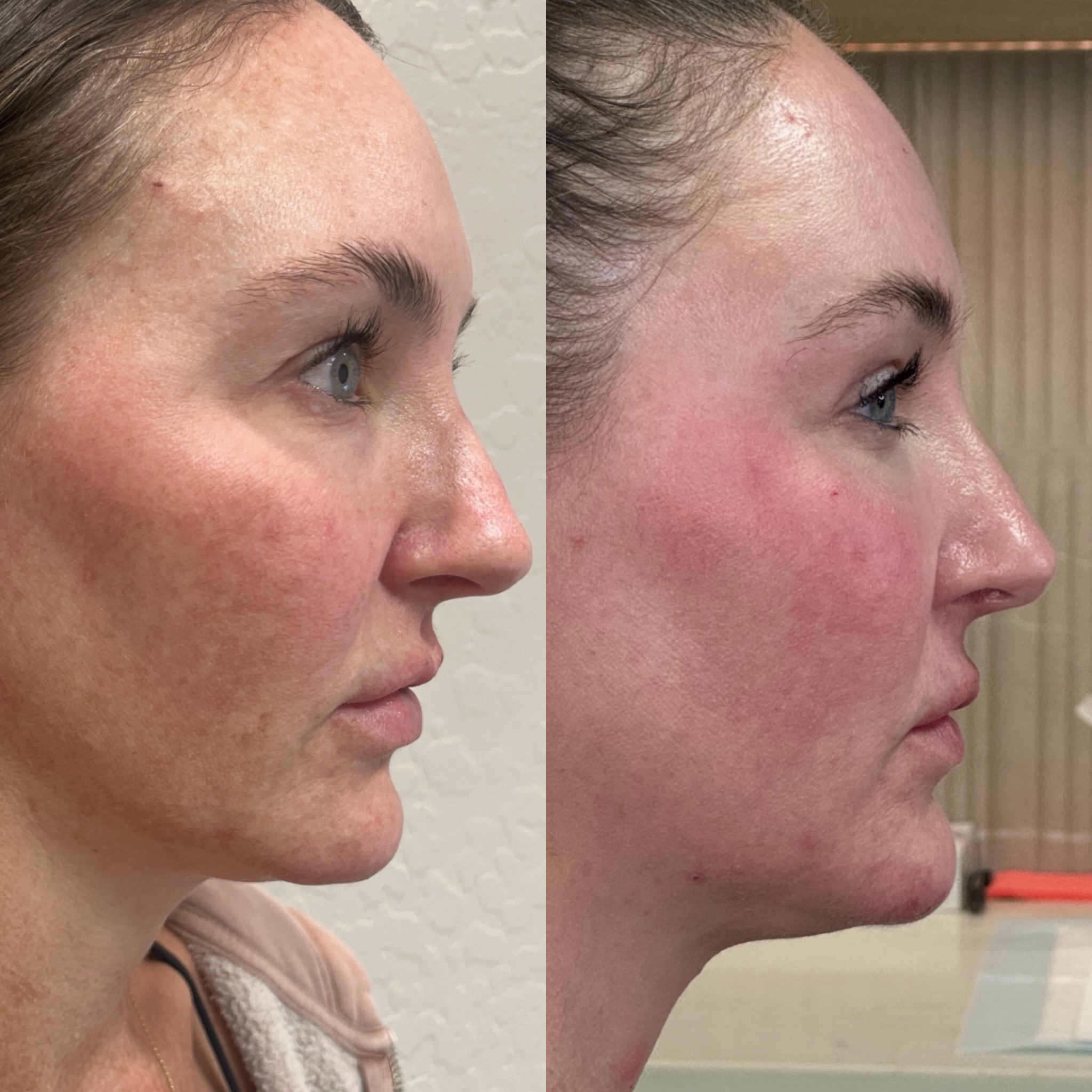 Laser coring eye and Clear Face, Neck & Chest3