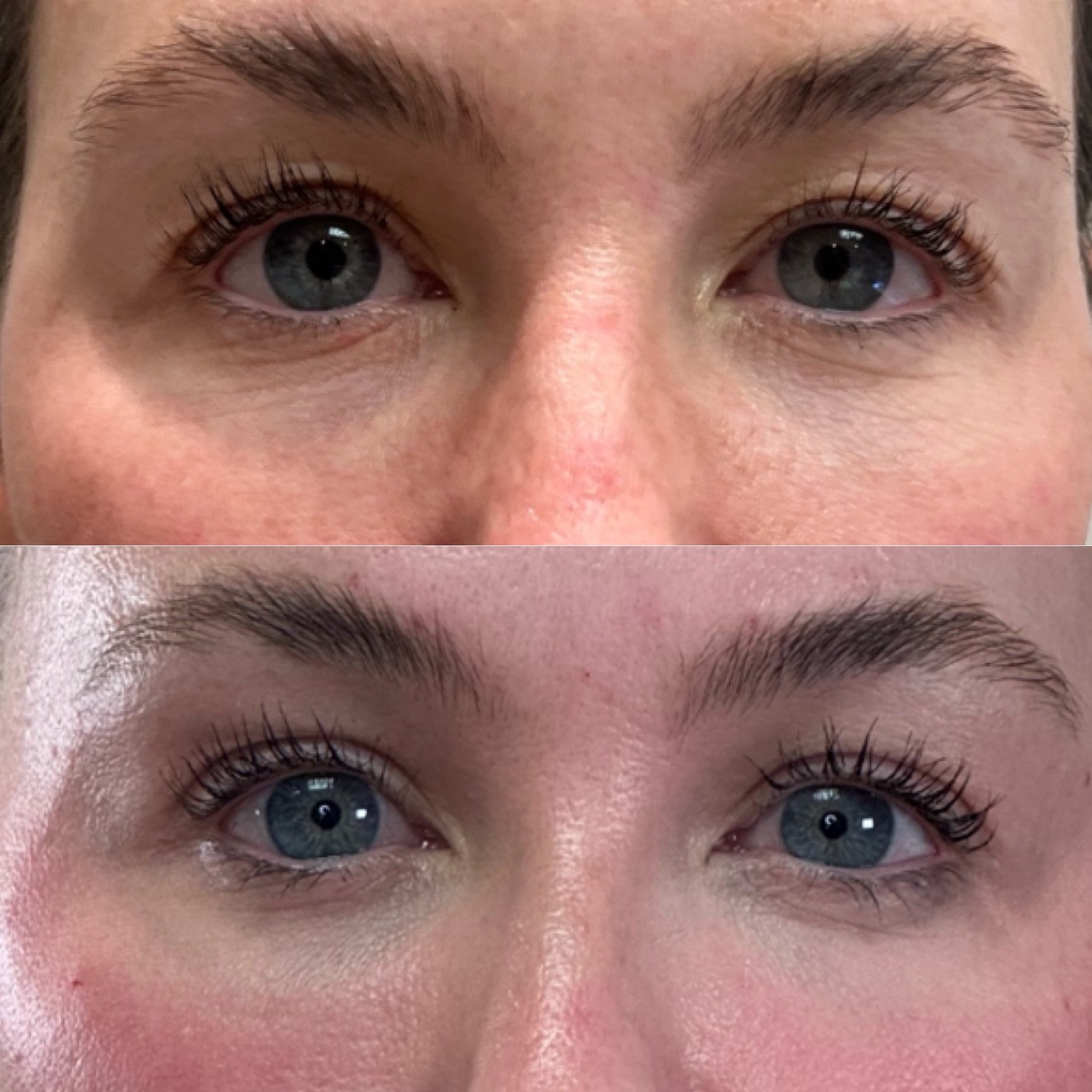 Laser coring eye and Clear Face, Neck & Chest4