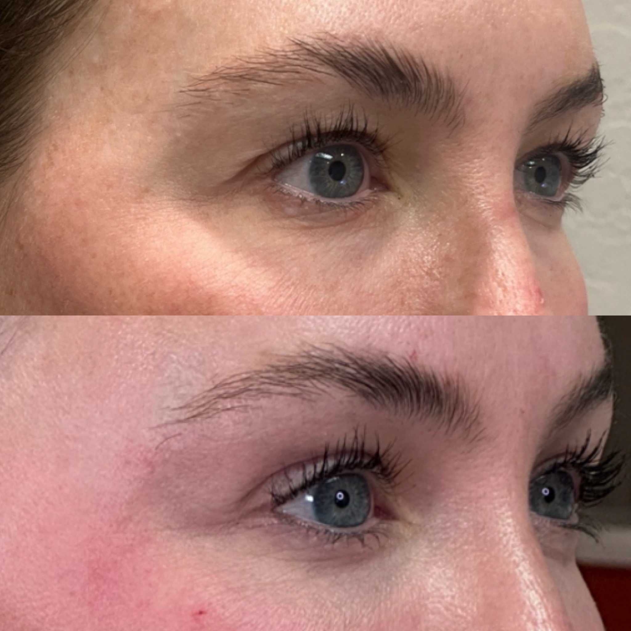 Laser coring eye and Clear Face, Neck & Chest5